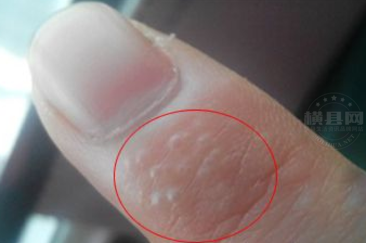 横县友仔手指长满小水泡,很痒还脱皮!是什么鬼?