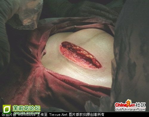 女人剖腹产全过程高清